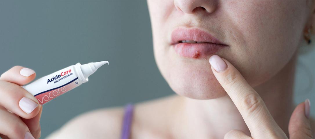 Acyclovir Creams and Treatment of Herpes Simplex Acyclovir Creams and Treatment of Herpes Simplex